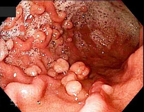 
Hình ảnh đa polyp tuyến gia đình
