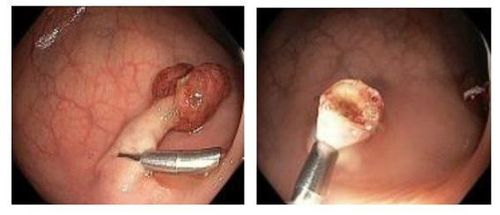 The procedure of laparoscopic right colectomy with enlarged lymph node dissection