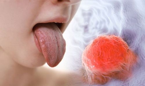 Stages of tongue cancer development and signs that are easy to miss