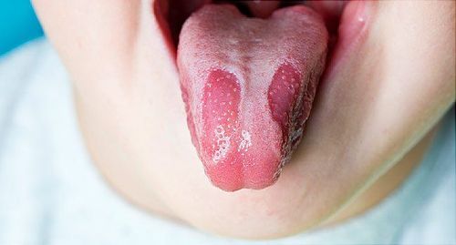 Diagnosis and treatment of glossitis in children