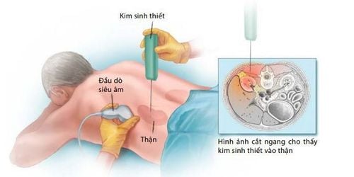 
Các bước tiến hành sinh thiết thận dưới cắt lớp vi tính
