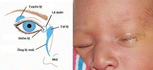 Nhận biết tắc lệ đạo ở trẻ sơ sinh