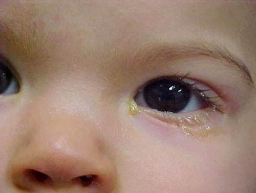 Trẻ sơ sinh hay chảy nước, có rỉ mắt là bị làm sao?