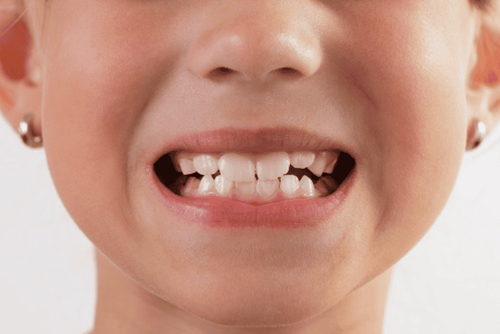 Hỏi đáp: Hiện tượng thay răng hàm sữa