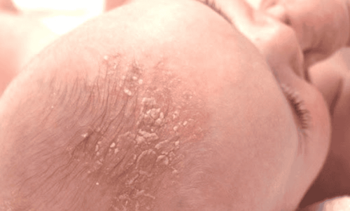 Viêm da tiết bã (cứt trâu trên đầu trẻ sơ sinh): Những điều cần biết