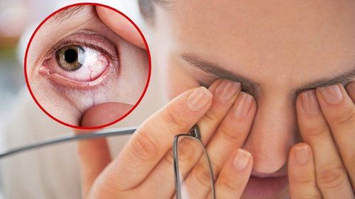 Vì sao bạn bị khô mắt sau mổ Lasik?