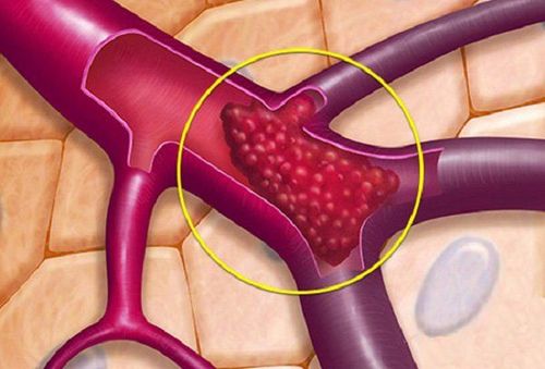 Huyết khối tĩnh mạch não: Chẩn đoán và điều trị