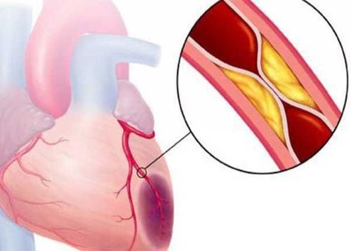 
Bệnh lý mạch vành cần được can thiệp
