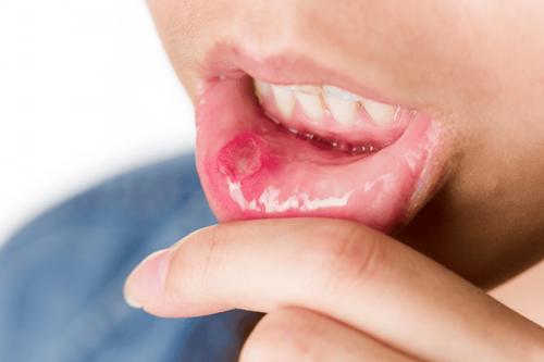 Learn about aphthous ulcers