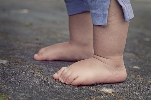 Crooked foot deformity in children