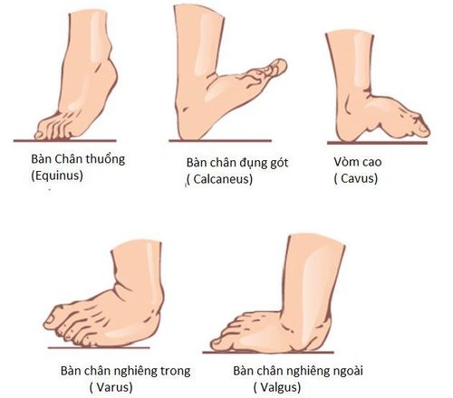 
Các kiểu bàn chân vẹo
