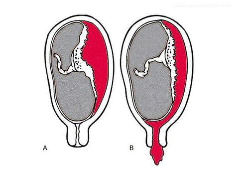 
Sót nhau có thể dẫn tới các vấn đề viêm nhiễm trong buồng tử cung
