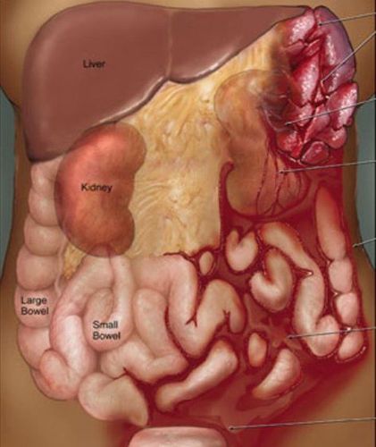 
Vỡ lách gây chảy máu trong ổ bụng
