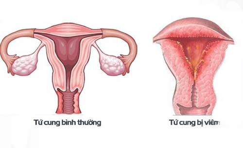 Endometritis is very common after childbirth