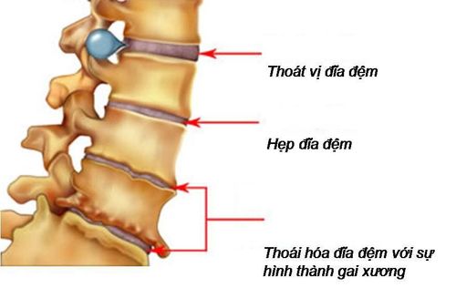 Magnetic resonance imaging for the diagnosis of spinal hernia