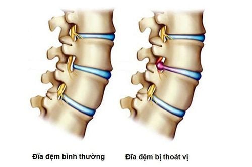 
Cột sống bị thoát vị
