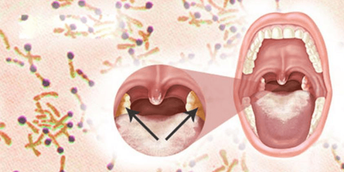 Diphtheria bacteria characteristics