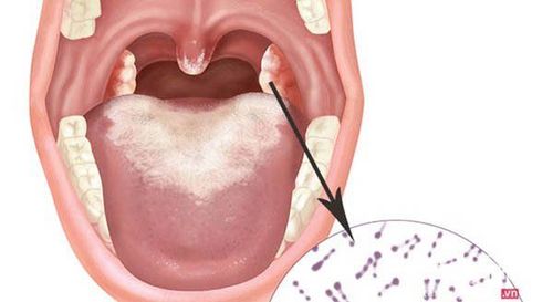 
Bệnh bạch hầu do vi khuẩn Corynebacterium diphtheriae
