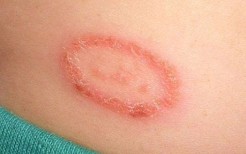 Can shingles recur?