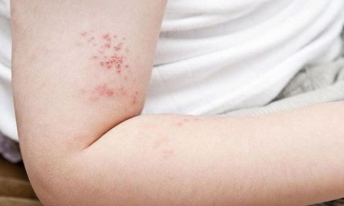 Is shingles in children dangerous?