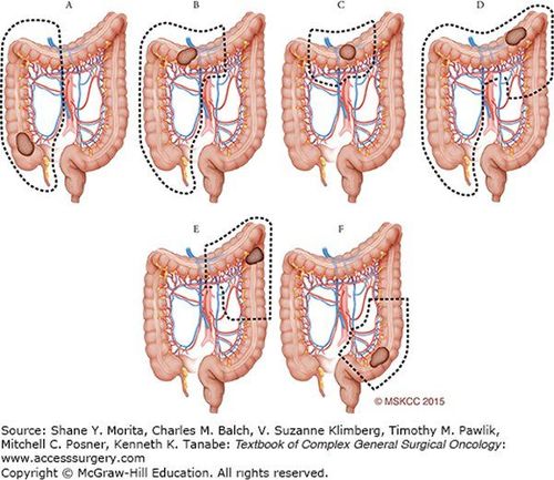 
Phương pháp điều trị ung thư đại tràng
