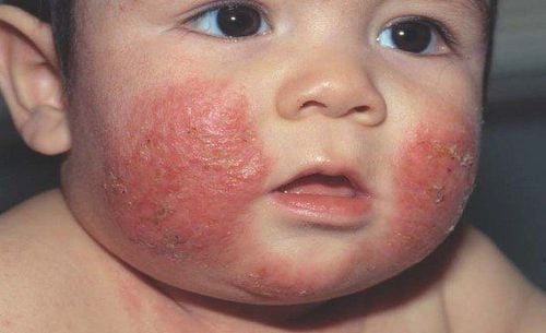 Treatment of atopic dermatitis in children