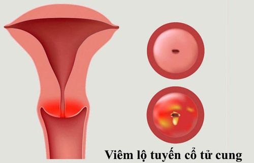 
Trong trường hợp lộ tuyến rộng, gây tiết dịch nhiều, kèm theo viêm, tái phát thì cần điều trị chống viêm bằng thuốc đặc hiệu
