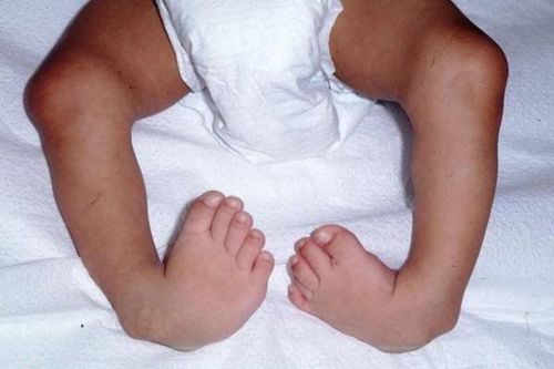 Khi nào có thể chữa bàn chân bị khoèo ở trẻ sơ sinh?