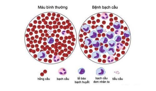 
Tế bào máu khi mắc bệnh bạch cầu mãn tính dòng lympho
