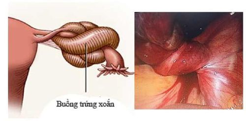 Treatment of torsion ovarian tumor