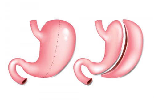 Can gastric cancer cells be eliminated after gastric bypass surgery?