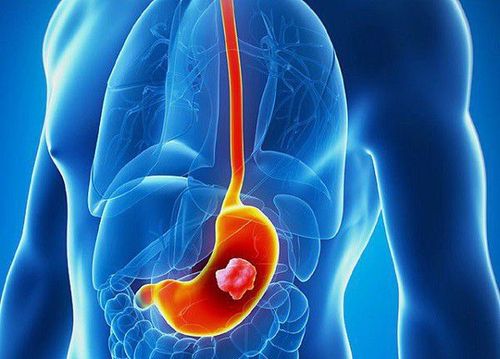 How is stomach cancer stage 2 treated?