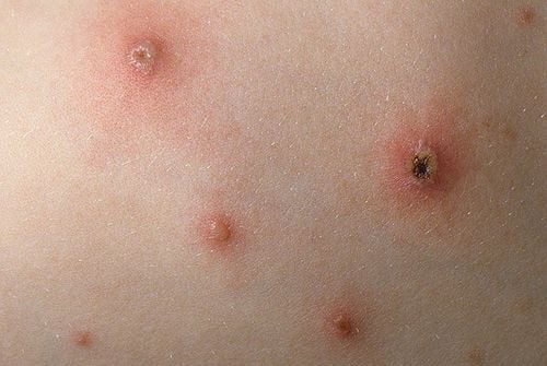 
Bệnh thủy đậu do virus Varicella gây ra
