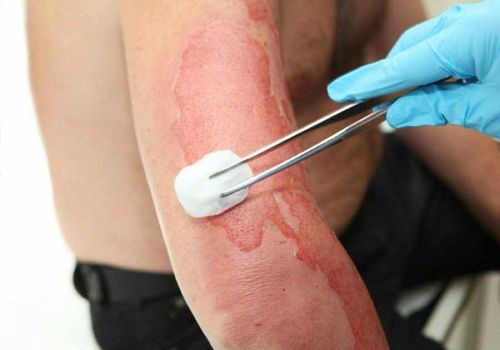 Causes and causes of burns