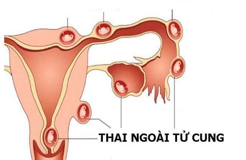 
Thai ngoài tử cung là tình trạng cấp cứu ngoại khoa nguy hiểm, nếu thai ngoài tử cung vỡ có thể gây chảy máu trong nửa đầu thai kỳ nghiêm trọng
