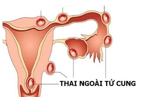 Surgery for ruptured ectopic pregnancy