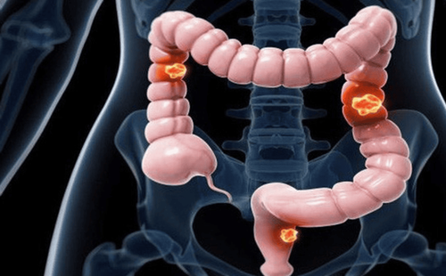 Causes and risk factors for colorectal cancer