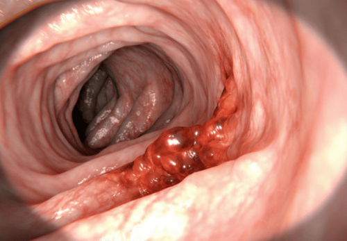 Overview and types of colorectal cancer