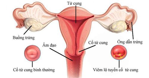 Điều trị viêm lộ tuyến cổ tử cung