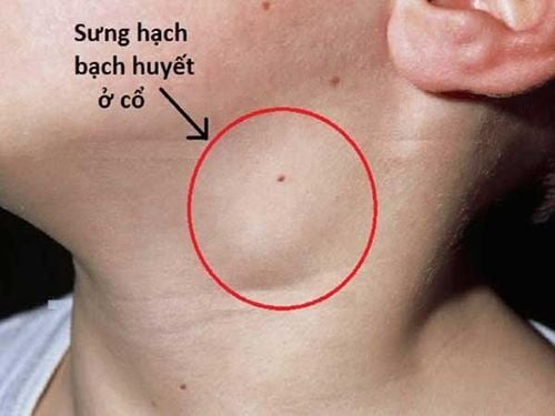 
Hạch bạch huyết có thể nằm ở nhiều vị trí trên cơ thể của trẻ như: cổ, vùng bẹn...
