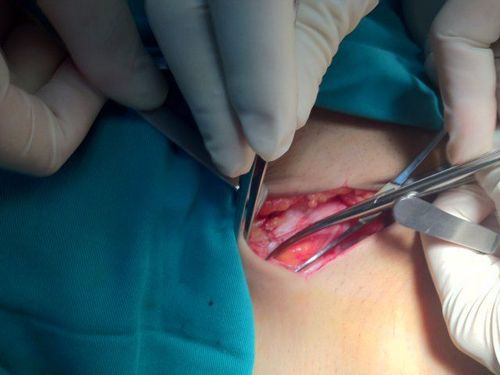 Is surgery for inguinal hernia dangerous?