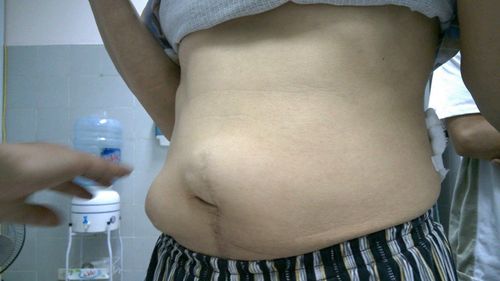 Treatment methods for hernia of the abdominal wall