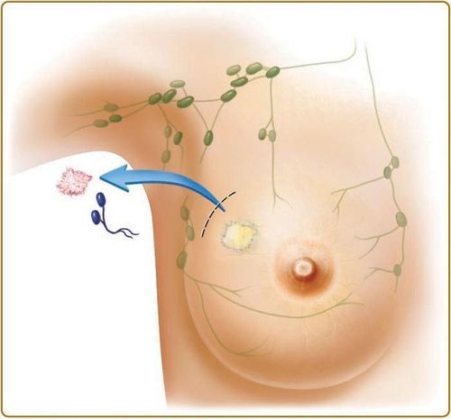 
Phẫu thuật bảo tồn tuyến vú để lại sẹo nhanh lành
