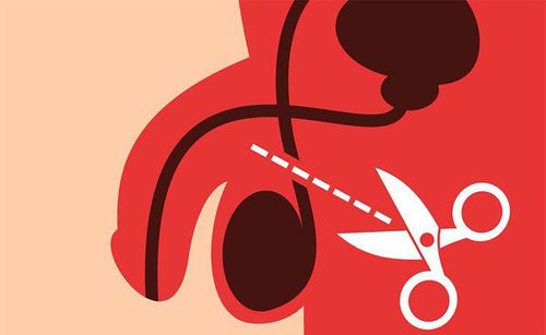 Male sterilization by vasectomy and ligation