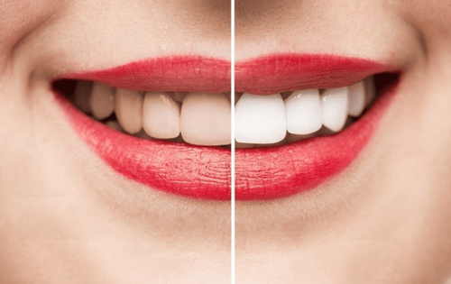 Learn about current teeth whitening methods