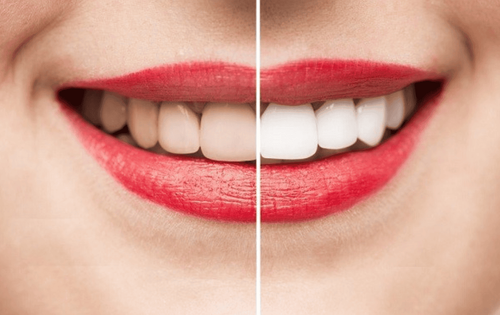 Giải đáp thắc mắc về tẩy trắng răng