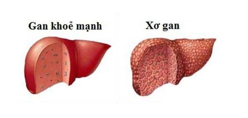 What do the results of measuring the degree of liver fibrosis say?