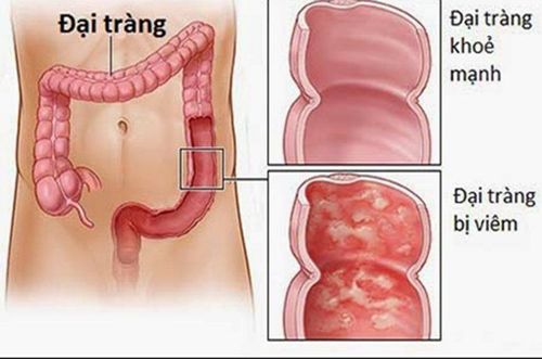 
Viêm đại tràng giả mạc xảy ra khi vi khuẩn trong ruột già phát hành độc tố mạnh
