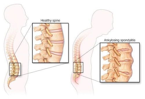 
Đa số người mắc bệnh viêm cột sống dính khớp có biểu hiện HLA-B27 dương tính
