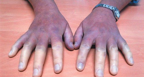 Scleroderma: Diagnosis and Treatment